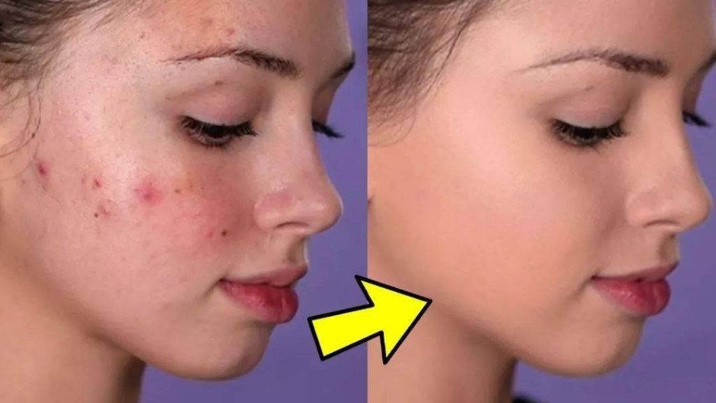 Best Cover up for Acne